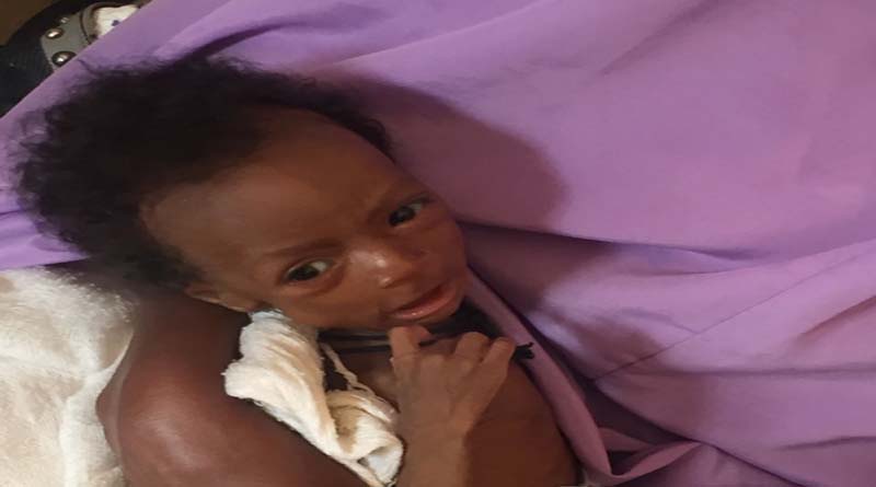 Six-month old Aisha Bilya looks frail and skeletal; she has very low weight for her height and clearly appears to be suffering from severe muscle wasting